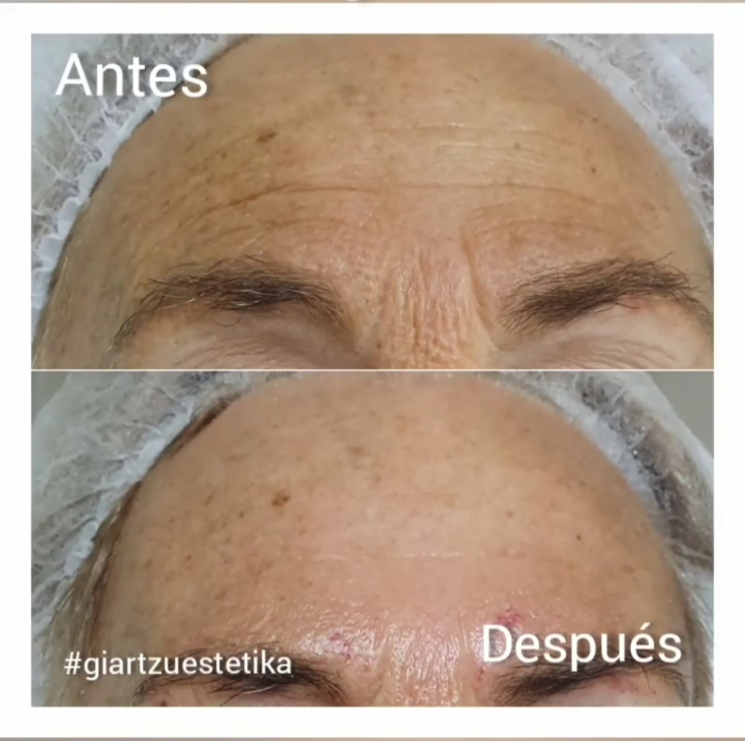Antes y después del tratamiento
