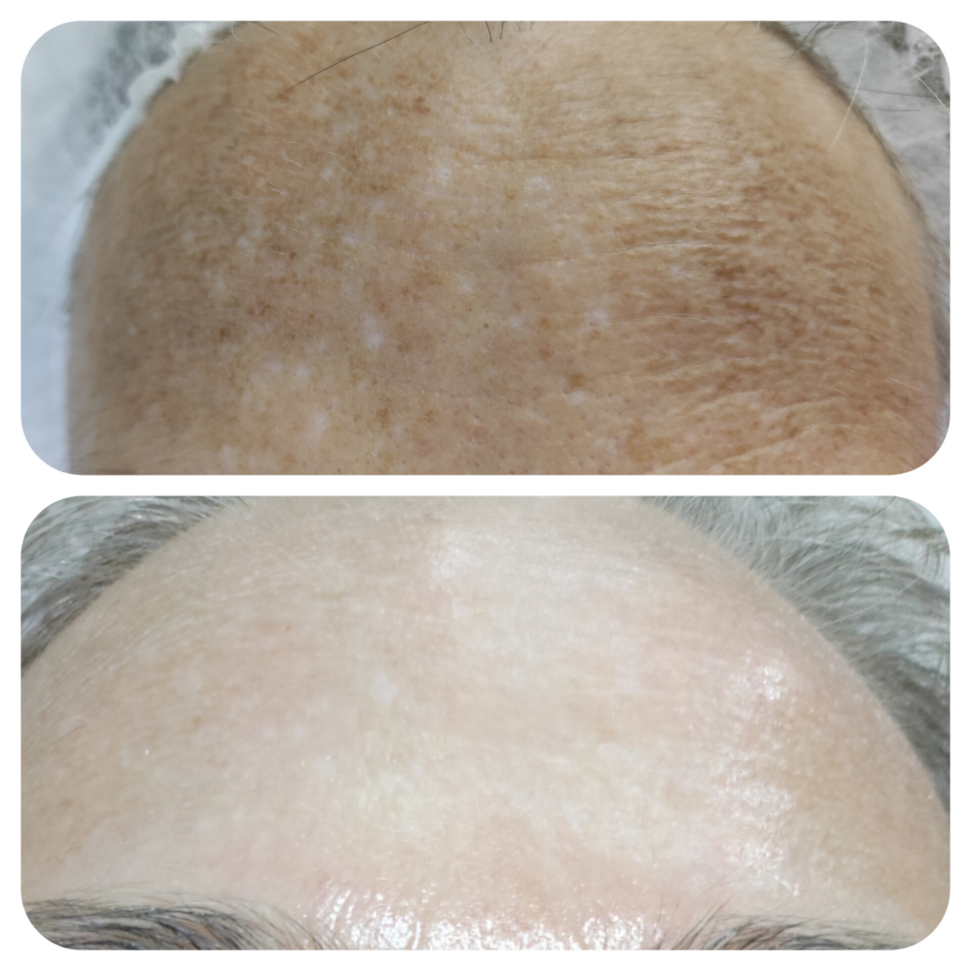 Antes y después del tratamiento